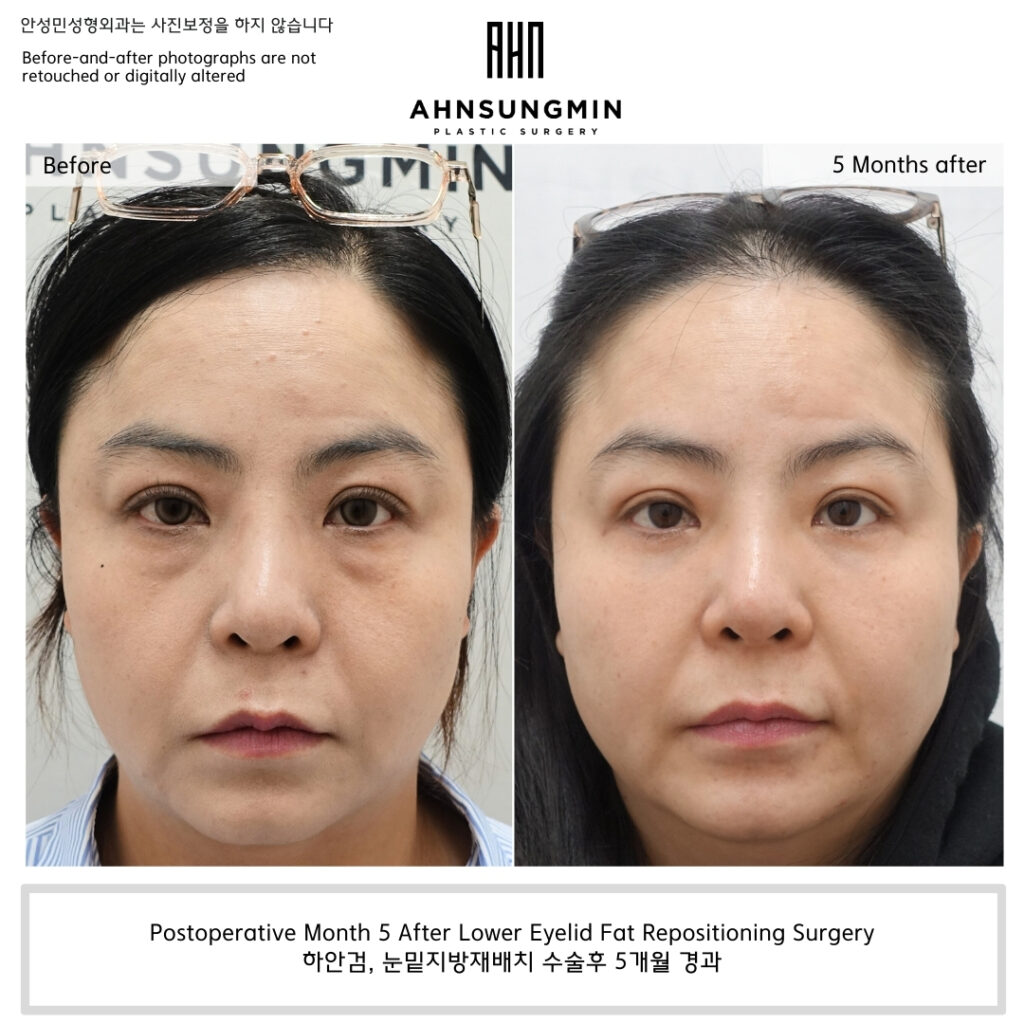 Before and five months after lower eyelid fat repositioning surgery showing smoother lid-cheek transition without excessive hollowing.