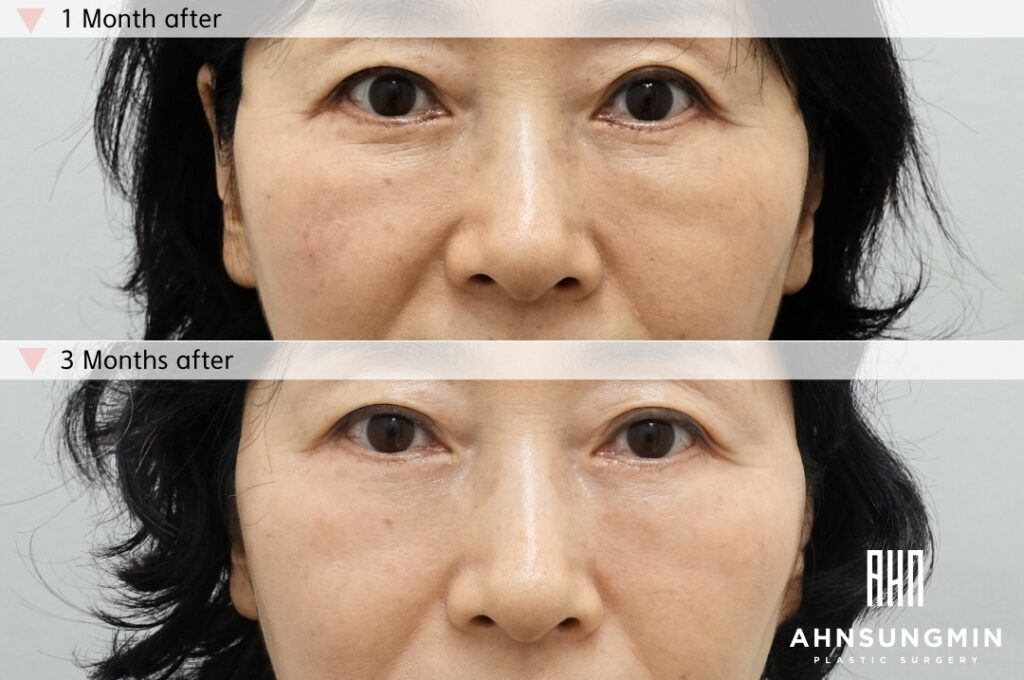Lower Blepharoplasty With Fat Repositioning – 1 Month and 3 Months After Surgery