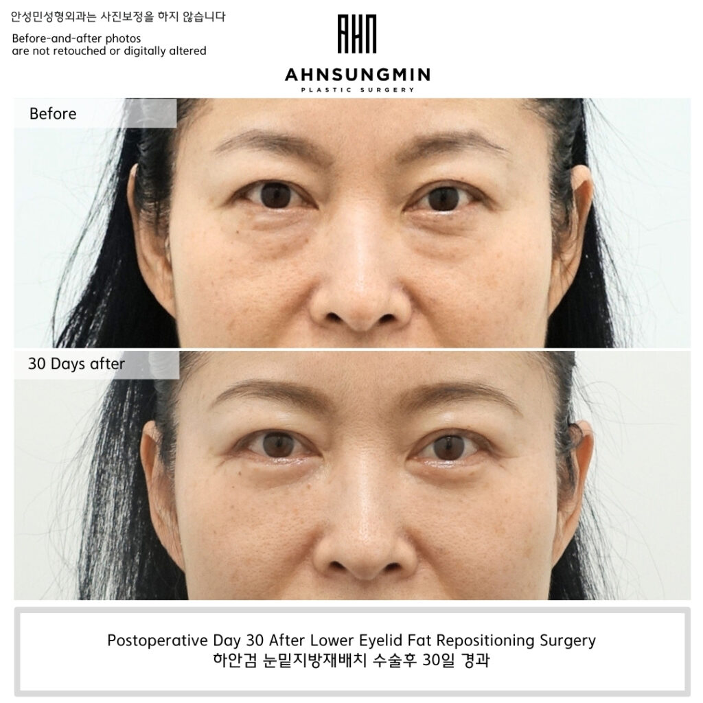 Lower eyelid fat repositioning surgery postoperative day 30 before and after comparison showing improved under-eye contour and reduced shadow