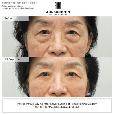 Postoperative Day 43 After Lower Eyelid Fat Repositioning Surgery.