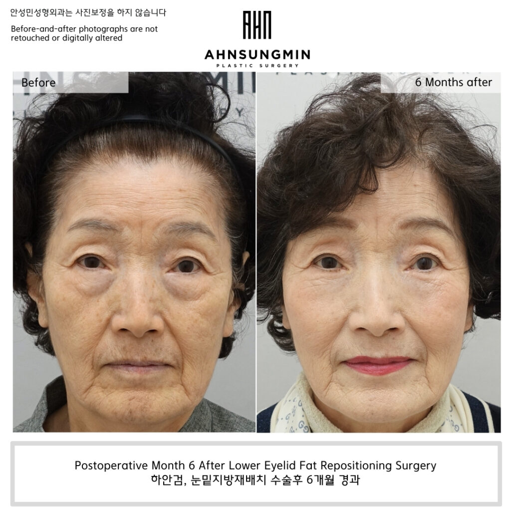 Six months after lower eyelid fat repositioning surgery showing improved under-eye contour and softened bulging without skin overcorrection.