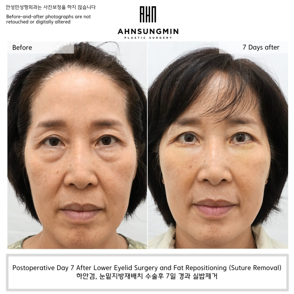 Postoperative Day 7 After Lower Eyelid Surgery and Fat Repositioning (Suture Removal) – early recovery stage after lower blepharoplasty