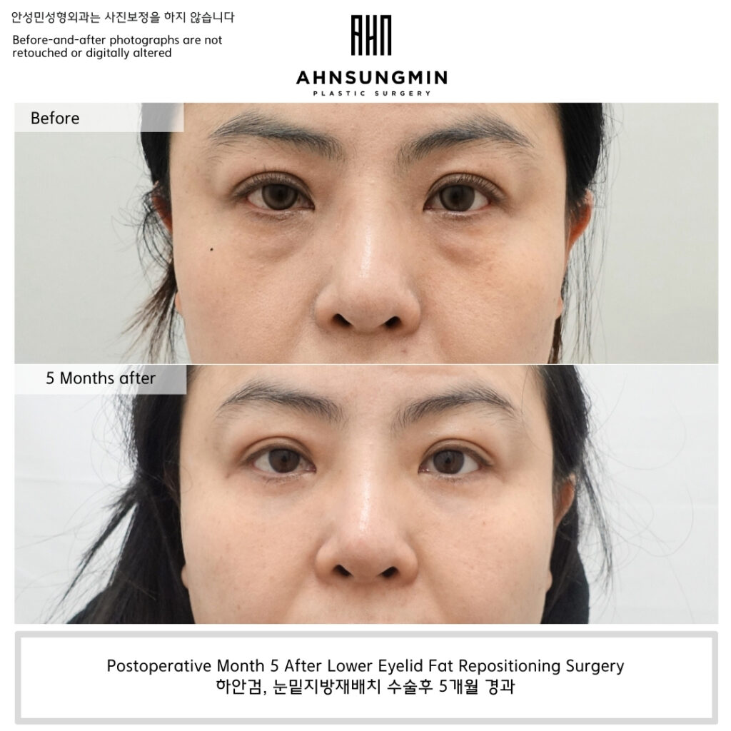 Close-up comparison five months after lower eyelid fat repositioning surgery showing improved tear trough contour without hollowing.
