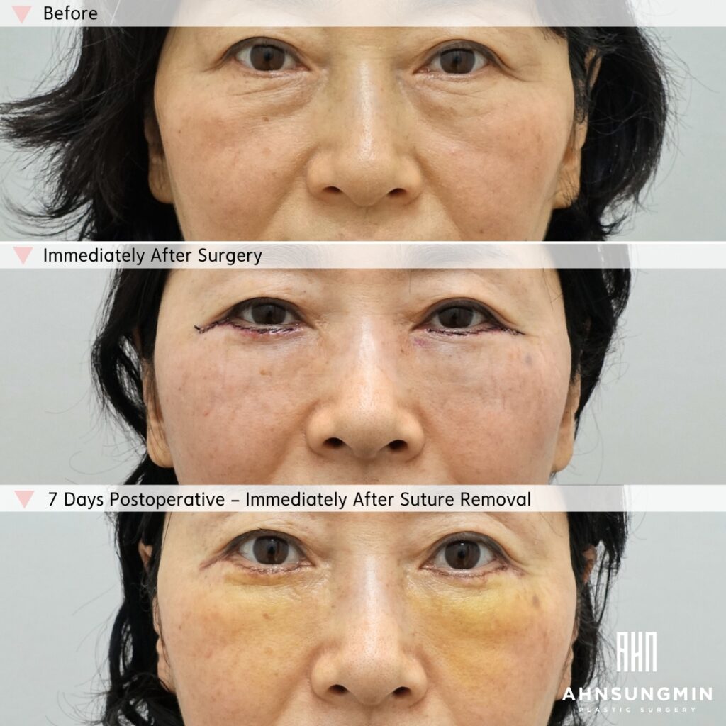 Lower Blepharoplasty With Fat Repositioning – Before, Immediately After Surgery, and 7 Days Postoperative