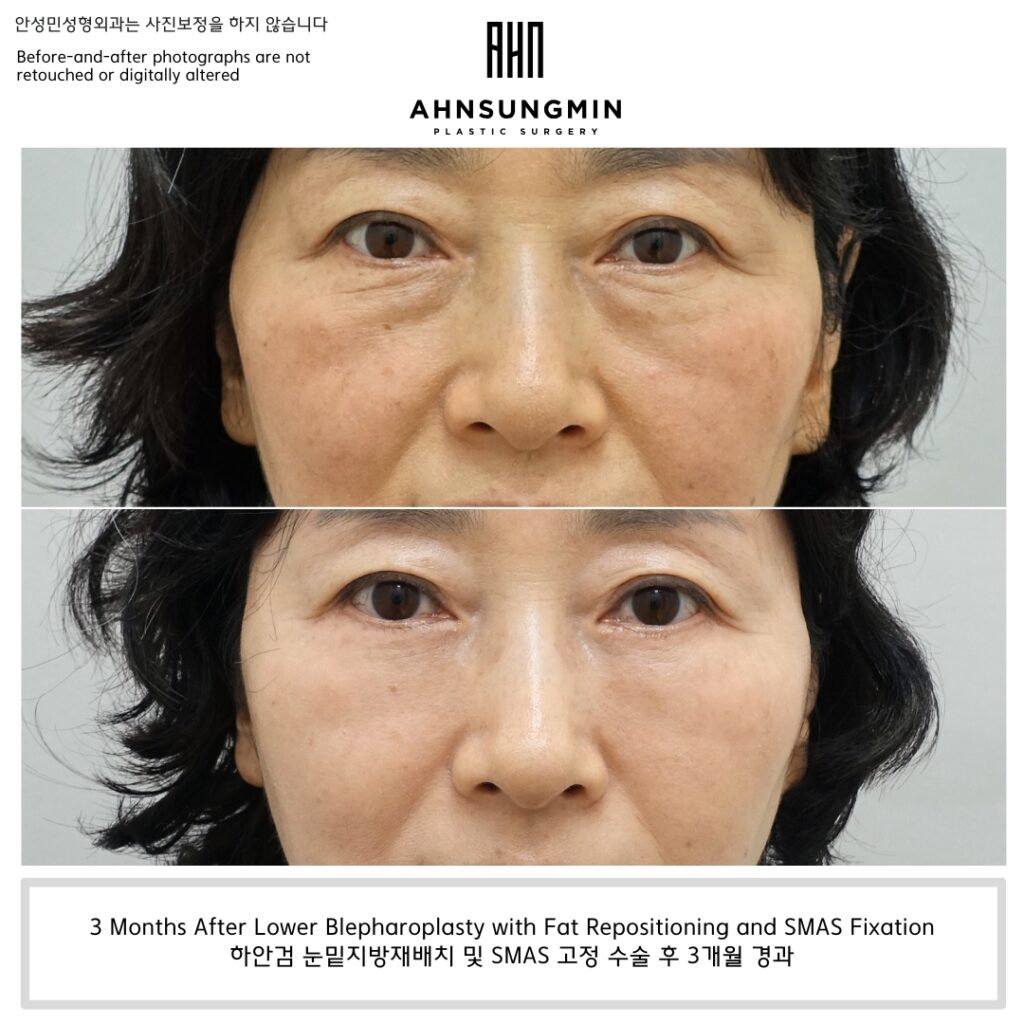 3 Months After Lower Blepharoplasty with Fat Repositioning and SMAS Fixation – Revision Lower Eyelid Surgery Result