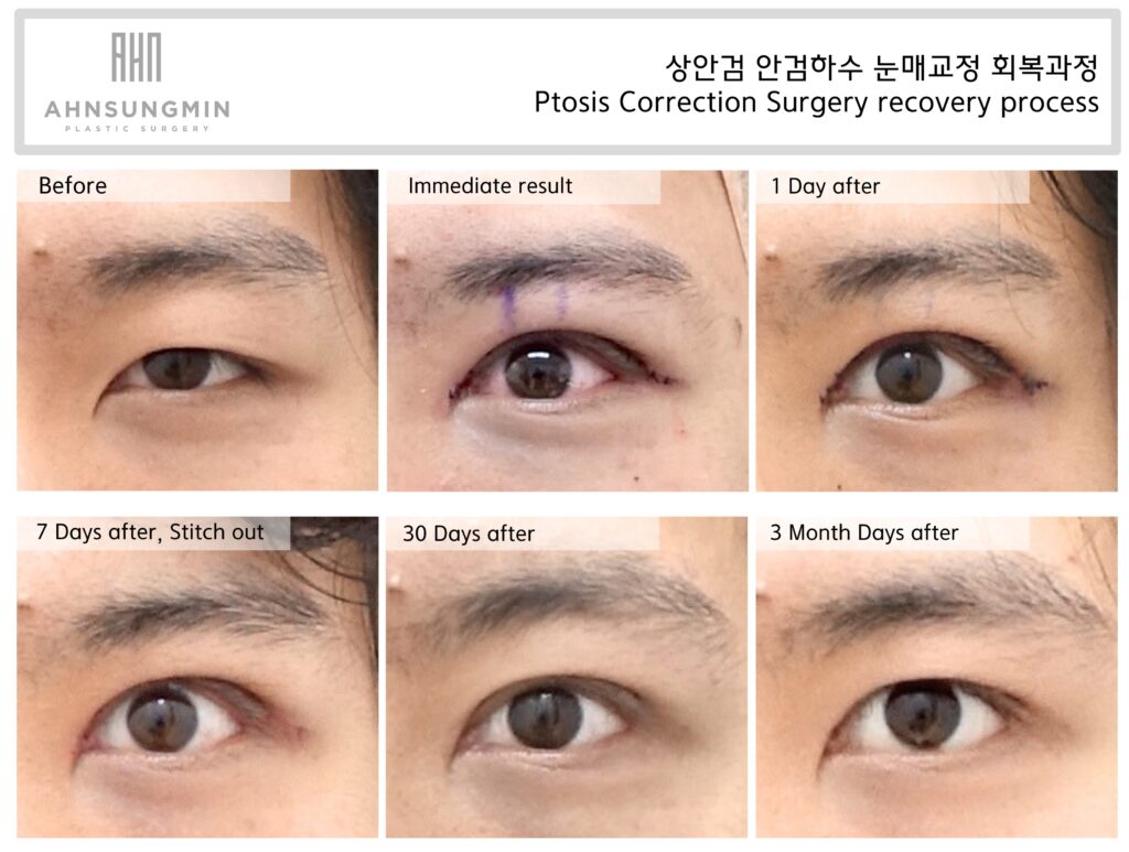 Ptosis Correction Surgery Recovery Process