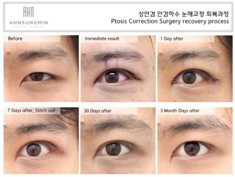 Ptosis Correction Is Not About Making the Eyes Bigger.