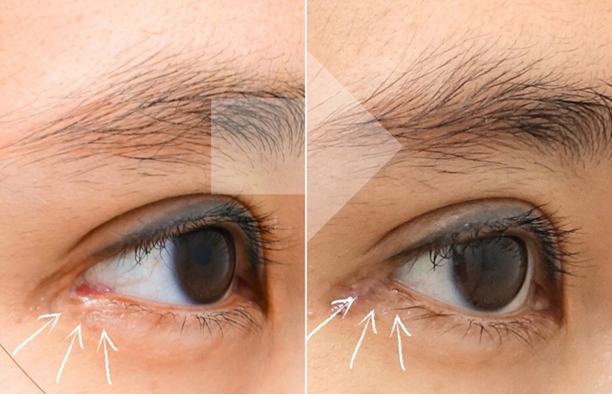 Side-angle preoperative and postoperative comparison after canthoplasty restoration surgery showing reconstruction of the lower outer corner contour and reduced excessive exposure
