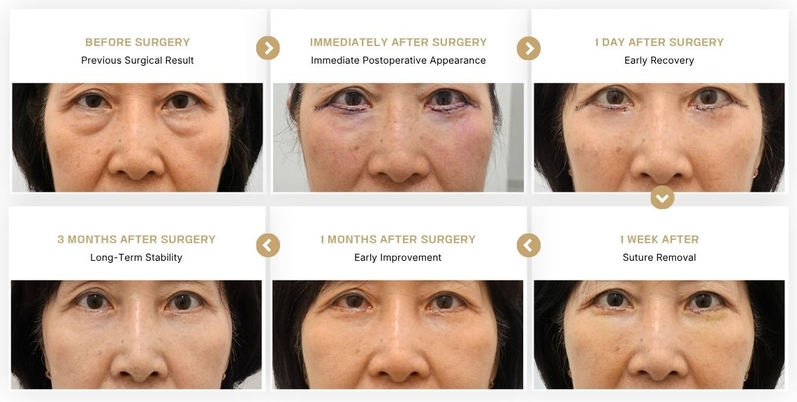 Lower blepharoplasty recovery timeline showing the progression from before surgery to immediately after surgery, 1 day, 1 week, 1 month, and 3 months after revision lower eyelid surgery in Korea.
