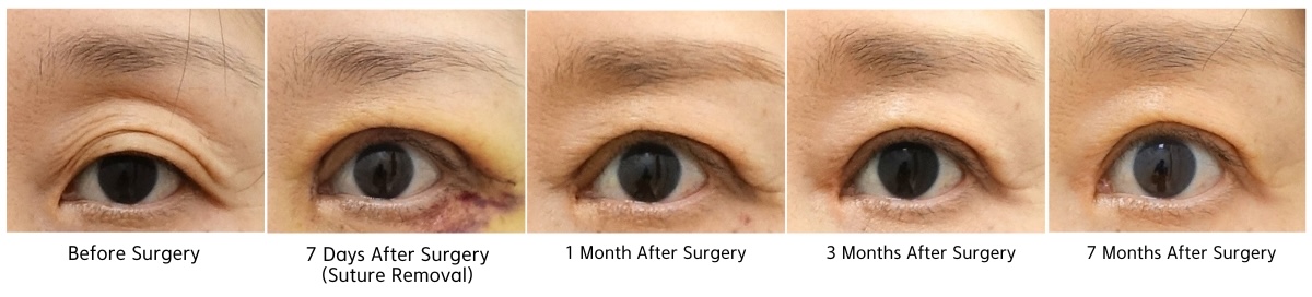 Recovery timeline after high fold revision surgery in Korea showing before surgery, 7 days after suture removal, 1 month, 3 months, and 7 months postoperative results
