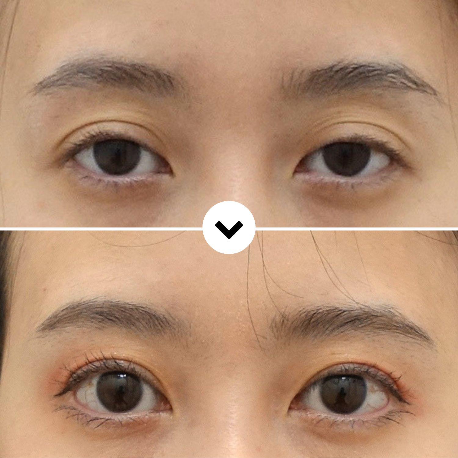 Asymmetry Correction Before and 1 Year After Revision Eyelid Surgery