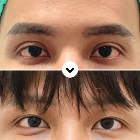 Why High Fold Correction Requires Functional Balance