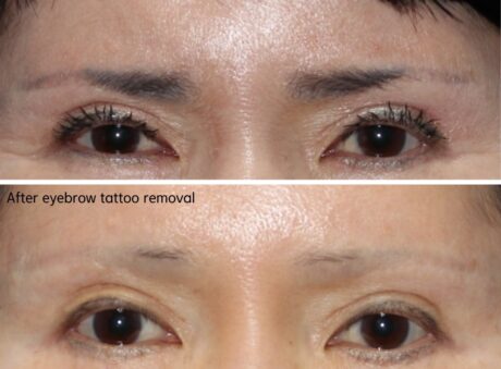 When Surgery Should Stop: A Case Where Revision Was Not Performed.