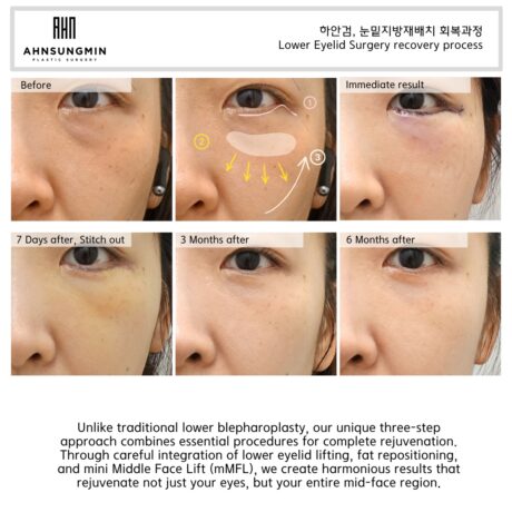 How to improve dark circles under the eyes?