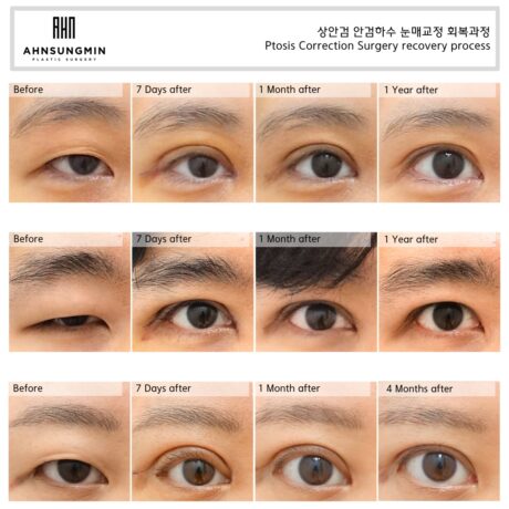 Eye Shape Correction Is Not About Making the Eyes Bigger.