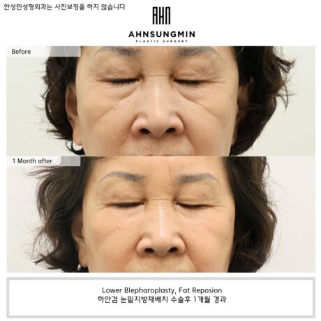 Why SMAS-Based Midface Lifting Is Important in Lower Blepharoplasty?