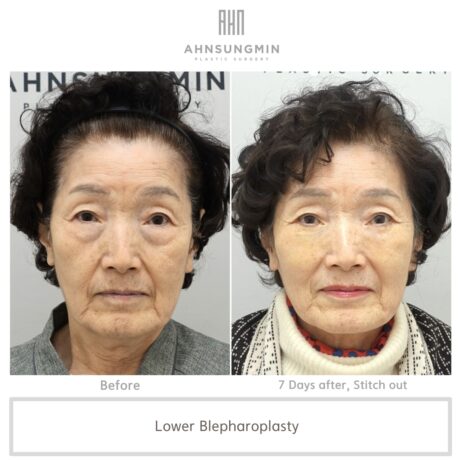 Lower eyelid surgery recovery process for a woman in her 70s