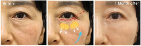 What We Consider Before Touching the Lower Eyelid.