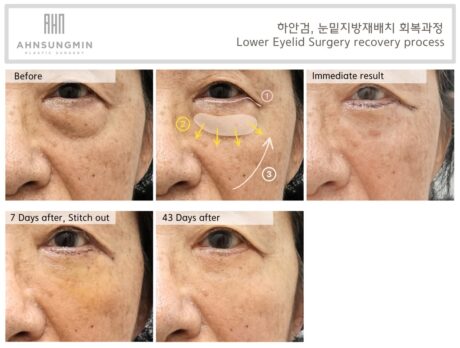 Why Excessive Skin Removal Leads to Ectropion in Lower Eyelid Surgery.