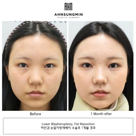 The Importance of Preserving the Aegyo-Sal in Lower Blepharoplasty