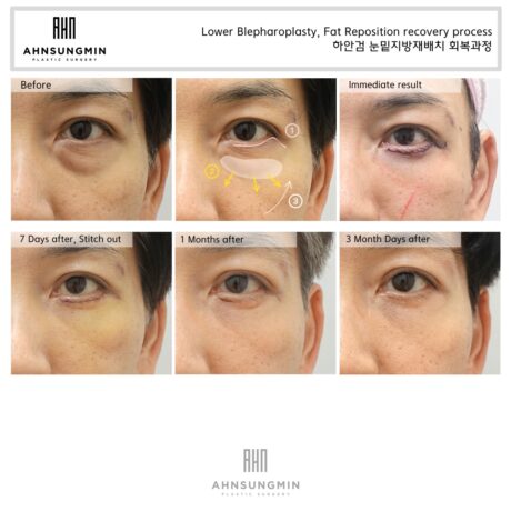 Lower eyelid surgery for middle-aged men