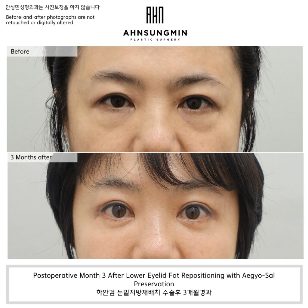 Lower eyelid fat repositioning surgery with aegyo-sal preservation, before and 3 months postoperative comparison showing improved under-eye support and natural volume balance.