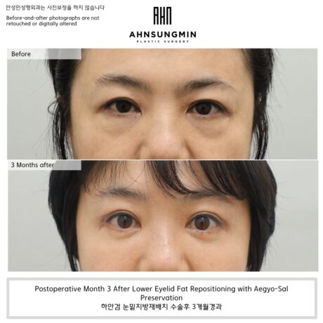 Why Preserving Aegyo-Sal Matters in Lower Eyelid Fat Repositioning.