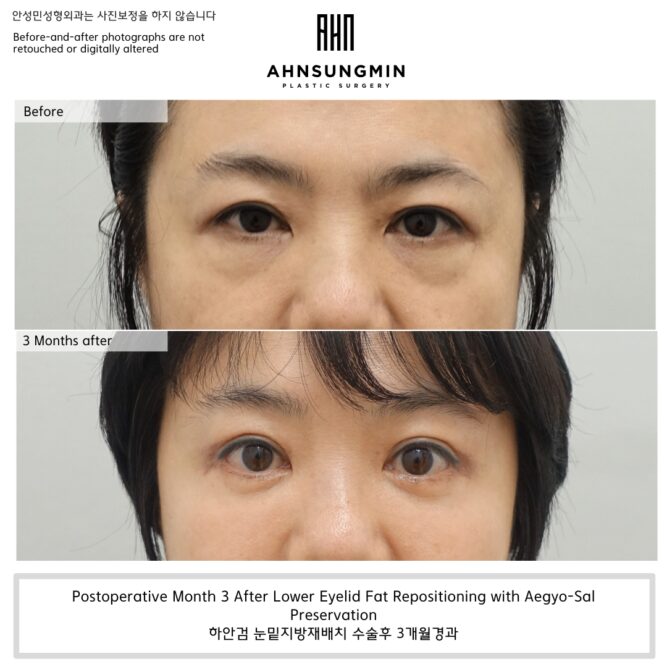 Why Preserving Aegyo-Sal Matters in Lower Eyelid Fat Repositioning ...
