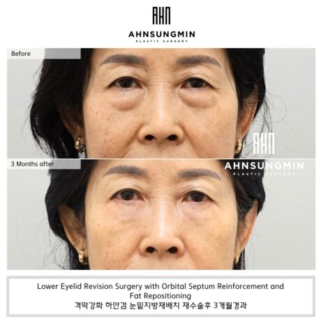 Is Lower Eyelid Fat Repositioning Revision Surgery Possible?