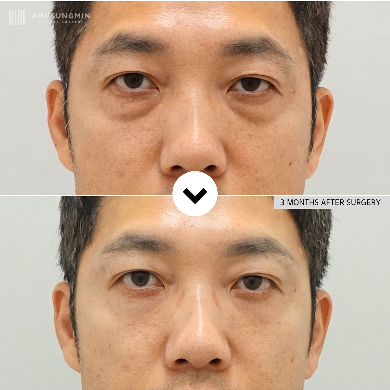 Before and 3 months after lower blepharoplasty in a male patient showing improved under-eye bags and smoother lower eyelid contours.