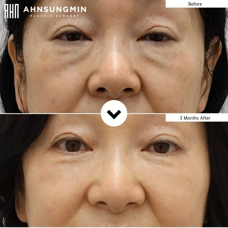 Lower eyelid surgery in Korea before and 3 months after with preserved under-eye volume
