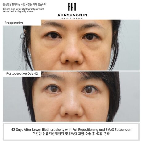 Why Preserving the Aegyo-Sal Matters in Lower Blepharoplasty.