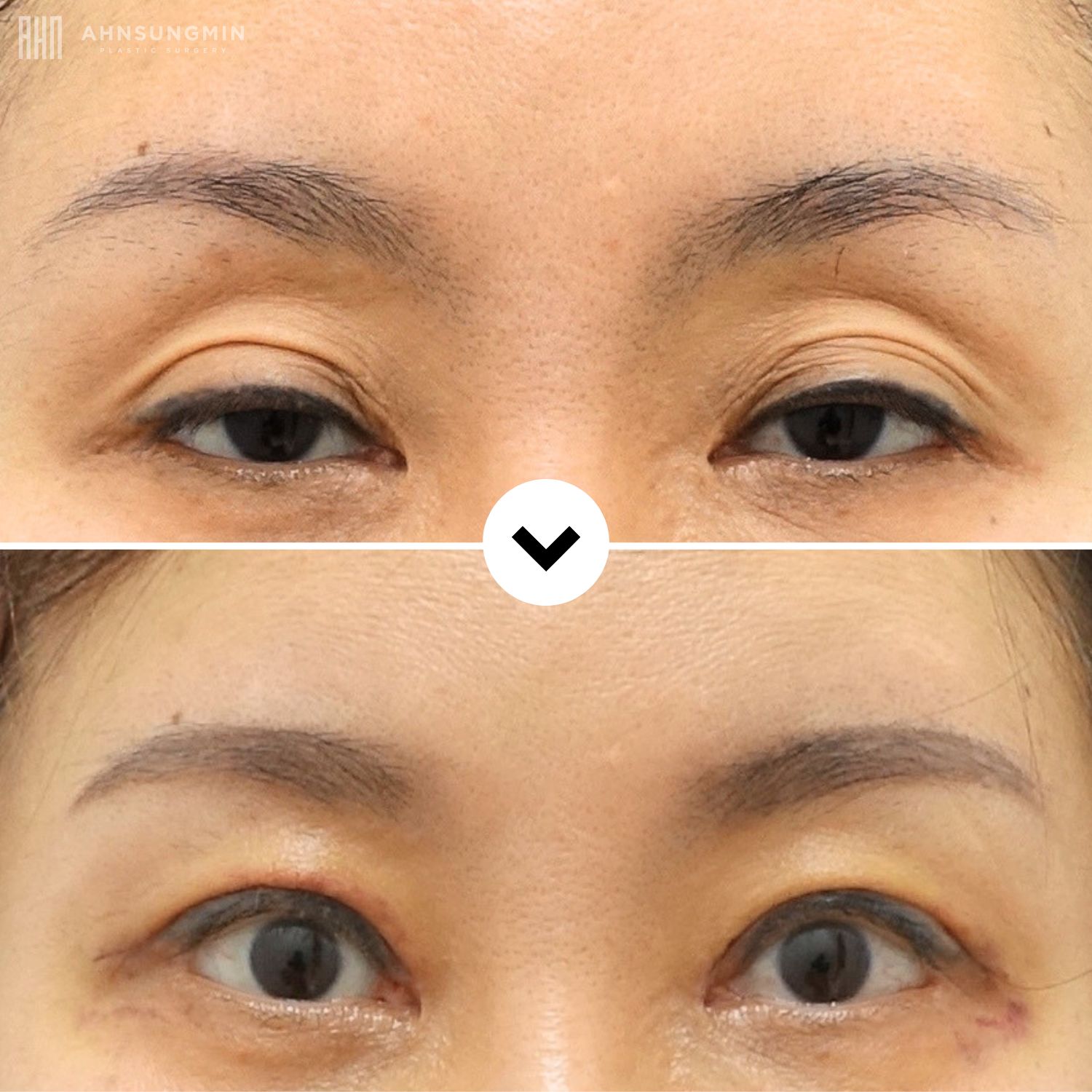 Before and after asymmetry correction in Korea showing improved eyelid balance and more symmetrical eye appearance.