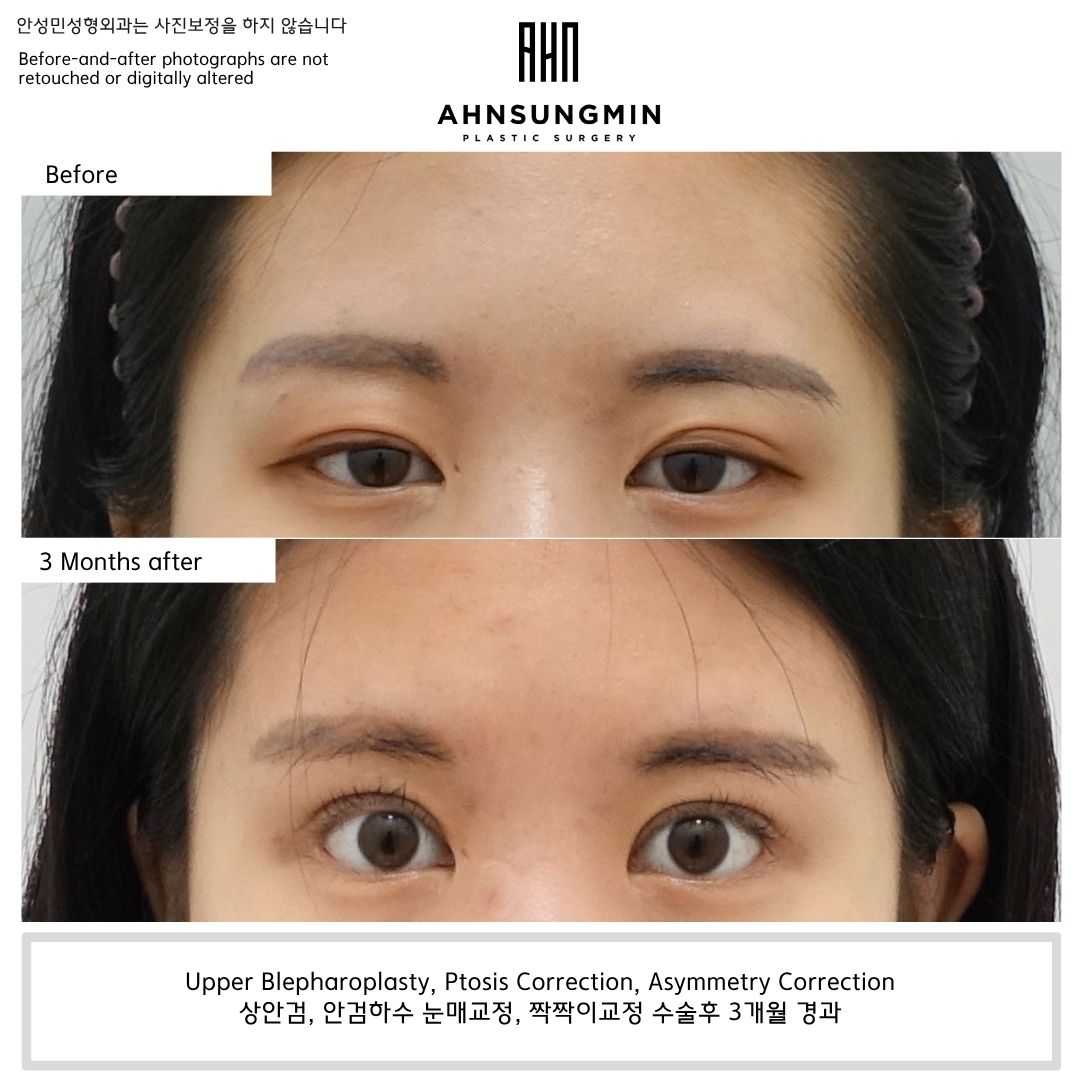 Upper blepharoplasty, ptosis correction, and asymmetry correction before and 3 months after surgery showing improved eyelid opening and enhanced eye symmetry