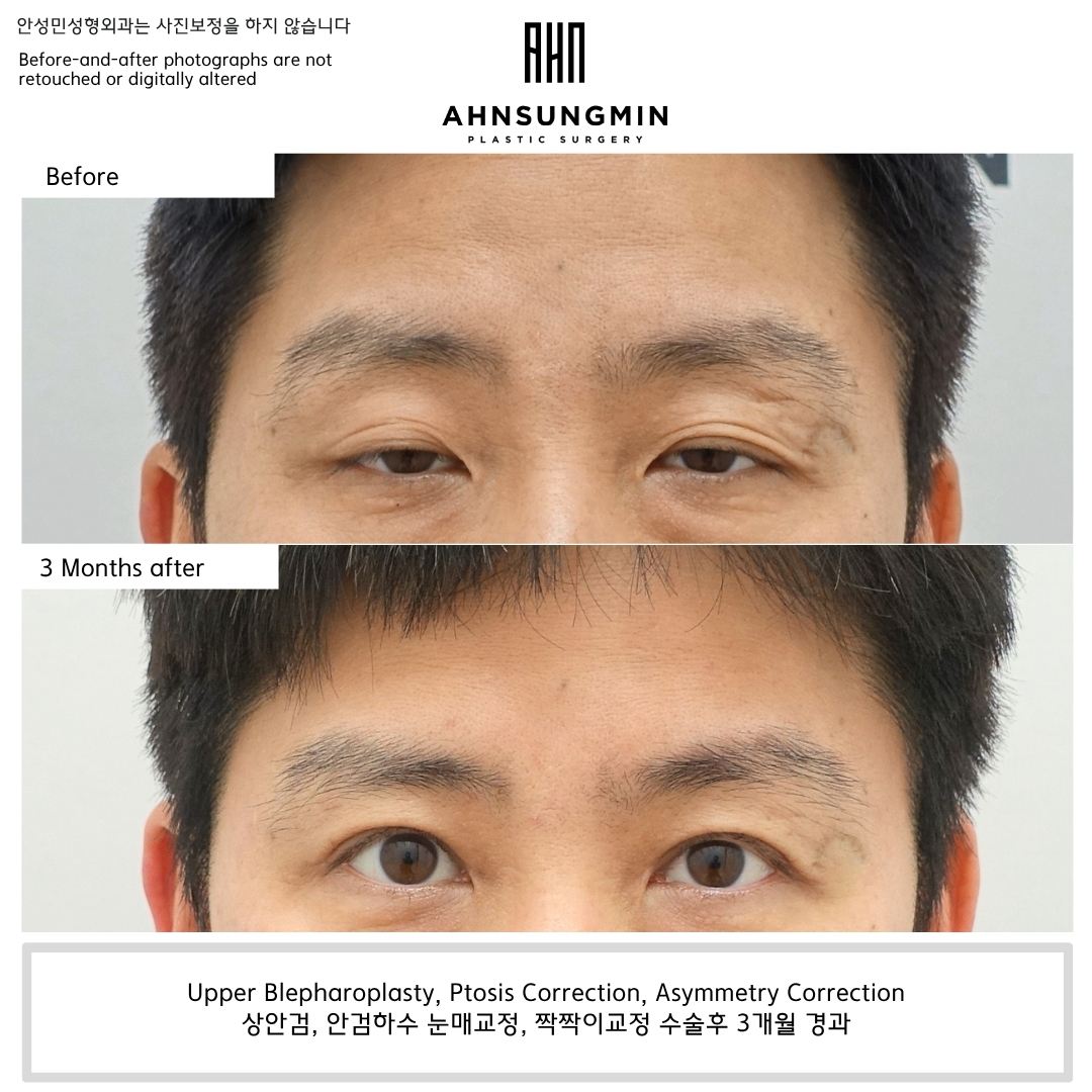 Upper blepharoplasty, ptosis correction, and asymmetry correction before and 3 months after surgery showing improved eyelid opening and balanced eye appearance