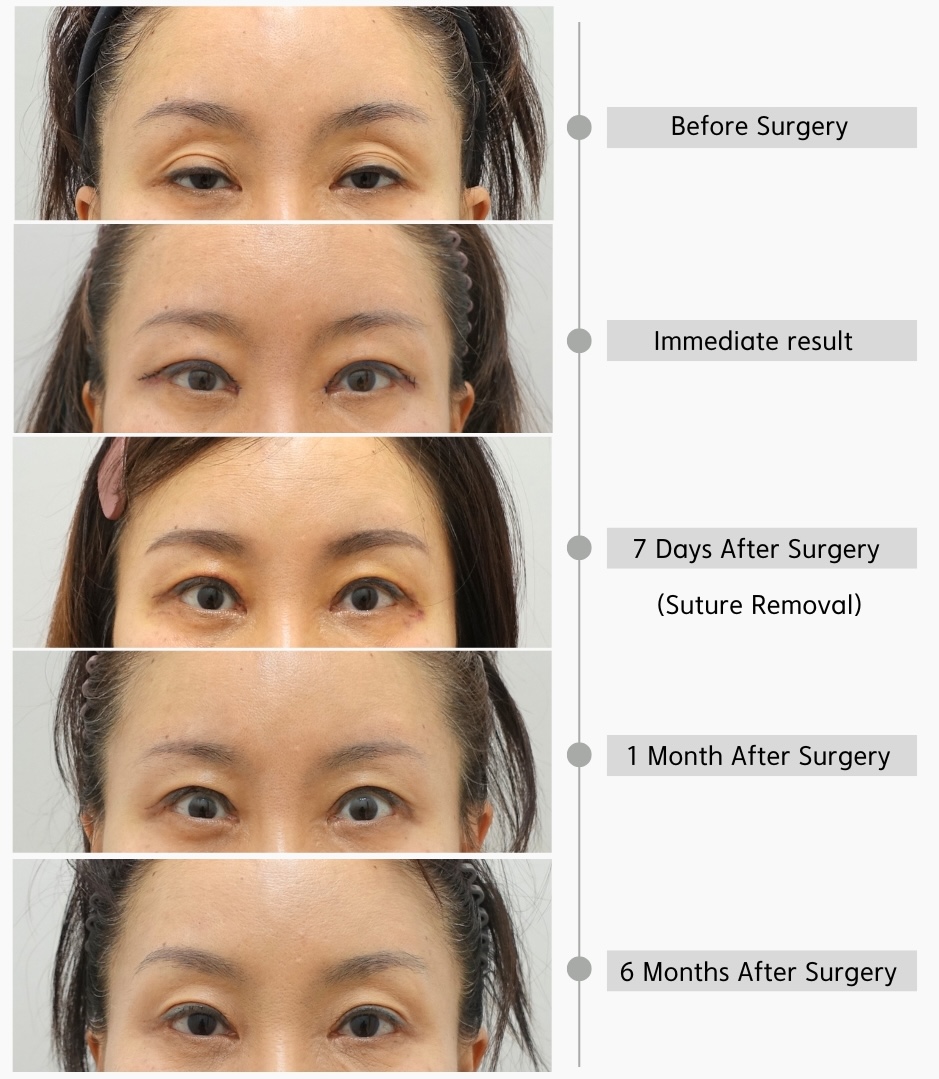 Uneven eyes correction recovery timeline showing before surgery, immediate postoperative result, 7 days after surgery, 1 month after surgery, and 6 months after asymmetry correction