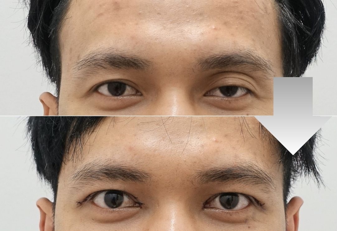 Best male eyelid asymmetry correction in Korea before and after showing balanced eyelid height and a natural masculine appearance.