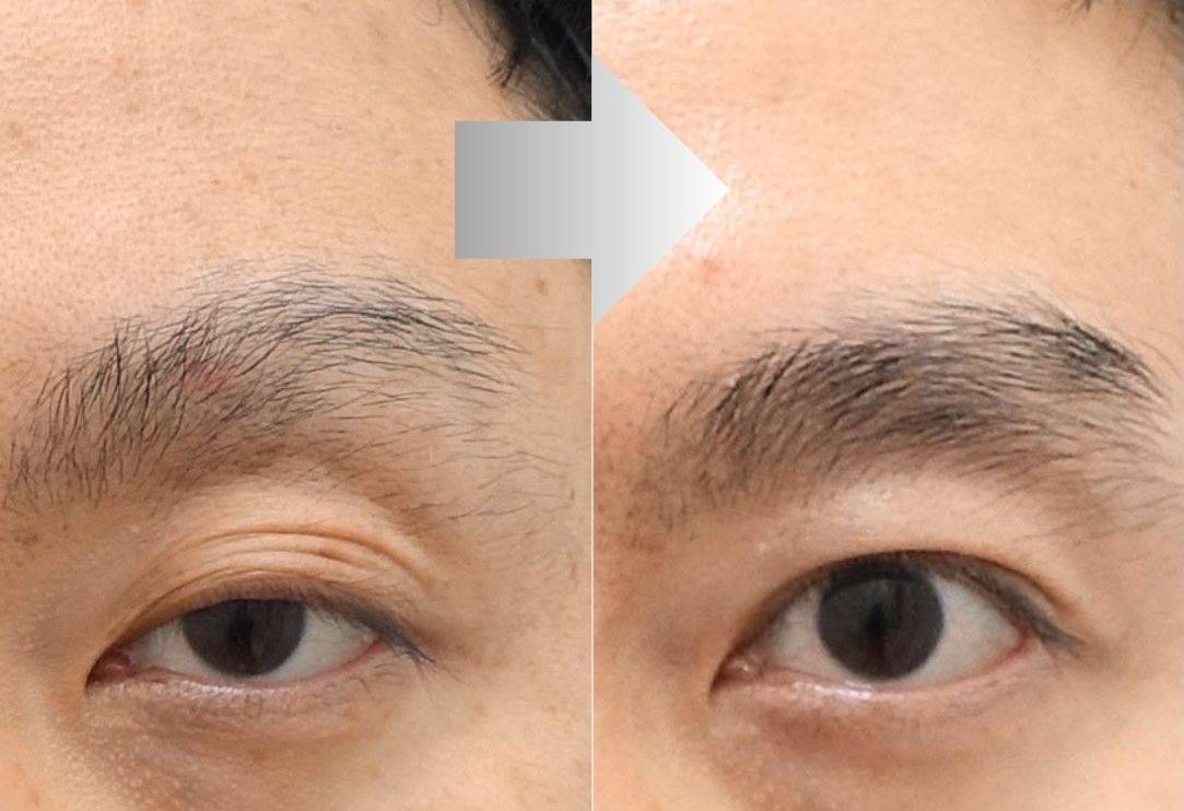 Best Male Multiple Fold Revision Surgery in Korea