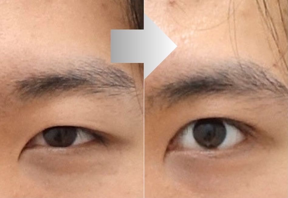 Best male residual ptosis correction in Korea before and after showing improved eyelid opening while preserving a natural masculine appearance.