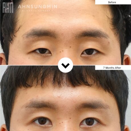 Why Sleepy Eyes in Men Often Require Ptosis Correction.