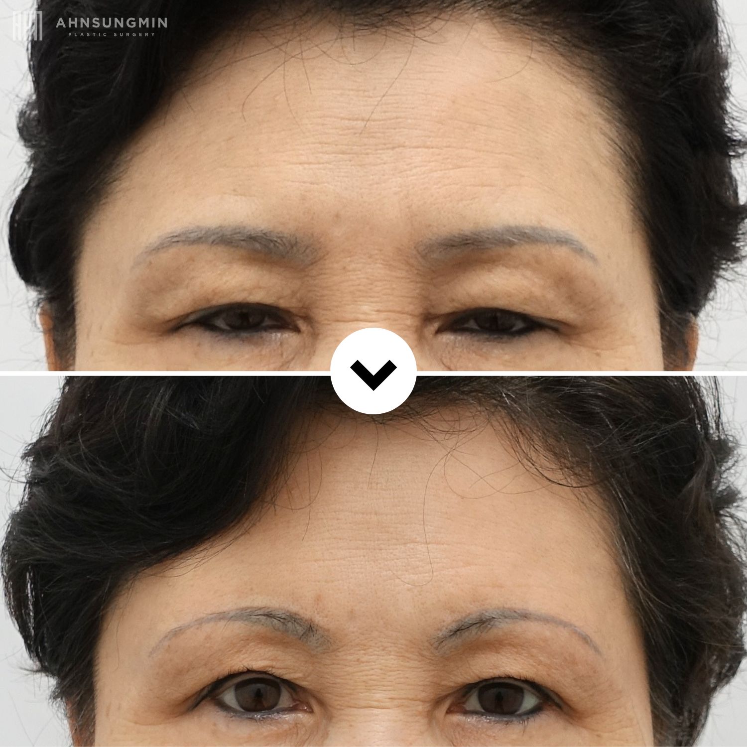 Before and after brow lift in Korea showing improved upper eyelid openness and a naturally elevated brow position.