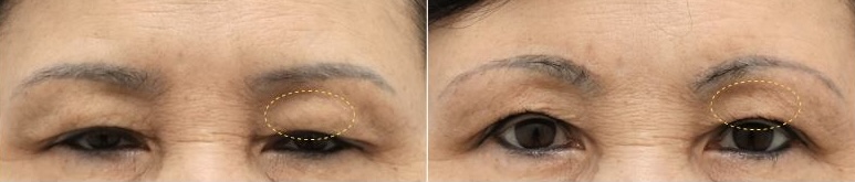 Before and 2-month postoperative brow lift surgery results showing improvement in heavy upper eyelid appearance and forehead compensation at Ahnsungmin Plastic Surgery Korea.
