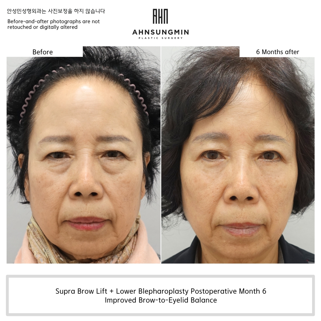 Supra brow lift and lower blepharoplasty before and after comparison showing improved brow position, upper eyelid openness, and lower eyelid contour at 6 months