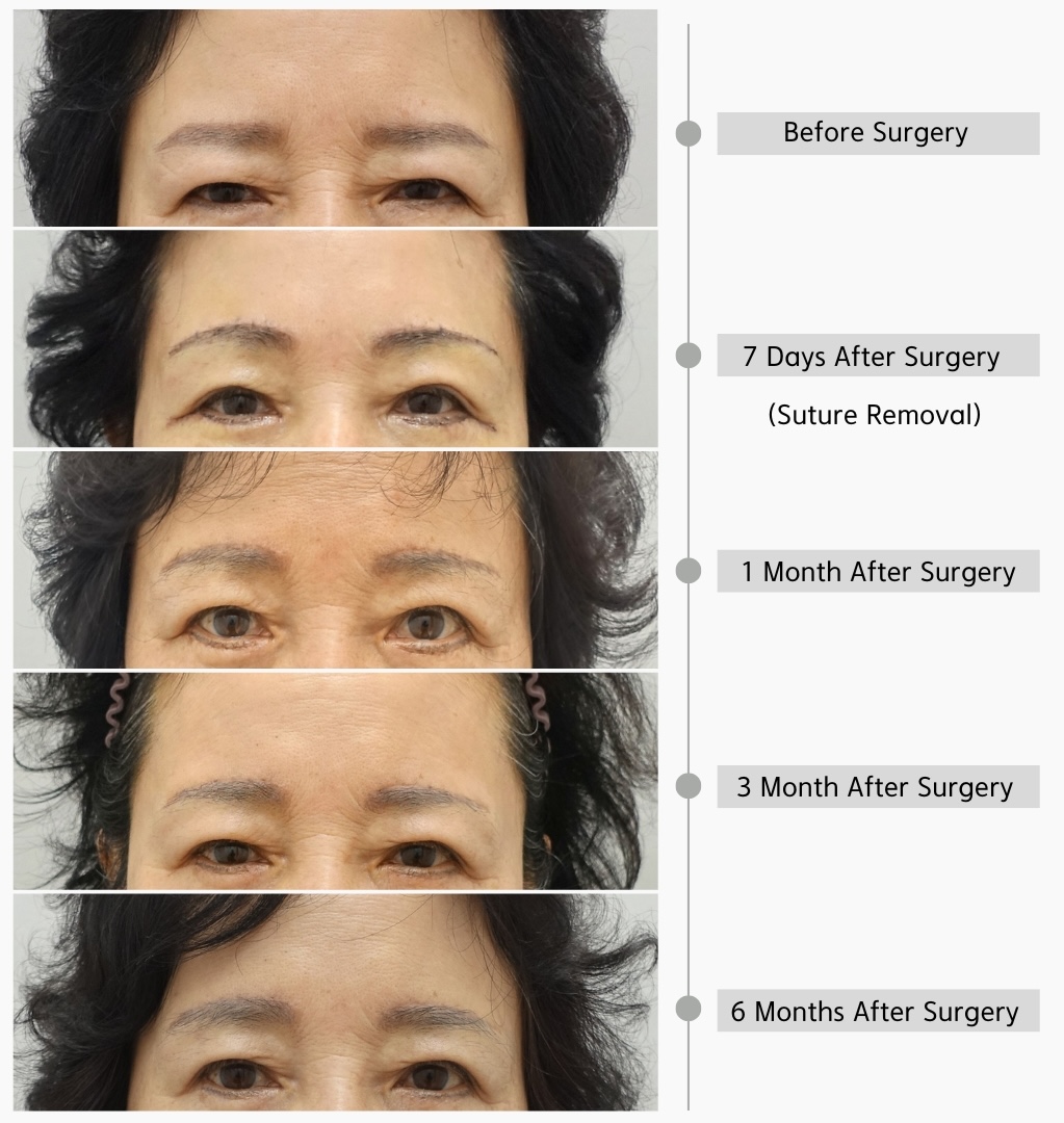 Brow lift recovery timeline showing preoperative appearance and progressive healing at 7 days, 1 month, 3 months, and 6 months after supra brow lift surgery.