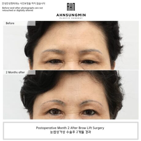 Why Forehead Compensation Can Make the Eyes Feel Heavy.