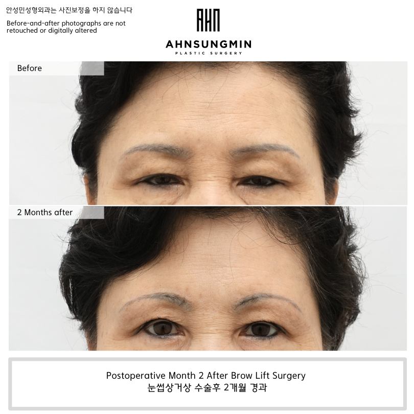 Postoperative Month 2 After Brow Lift Surgery at Ahnsungmin Plastic Surgery Korea showing improvement in heavy upper eyelids and forehead compensation.