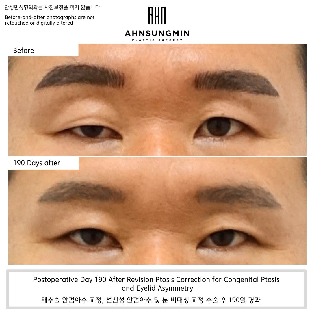 Congenital ptosis Korea revision surgery before and 190 days after correction of eyelid asymmetry