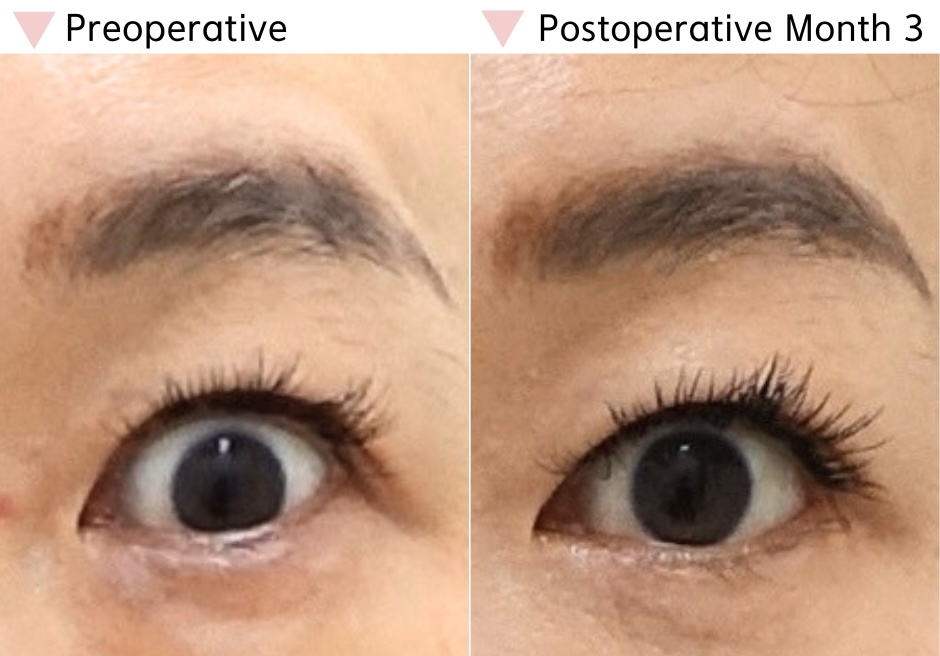 Preoperative and postoperative month 3 comparison showing improved eye balance and reduced upward outer corner tilt after dual canthoplasty when the eyes are fully open