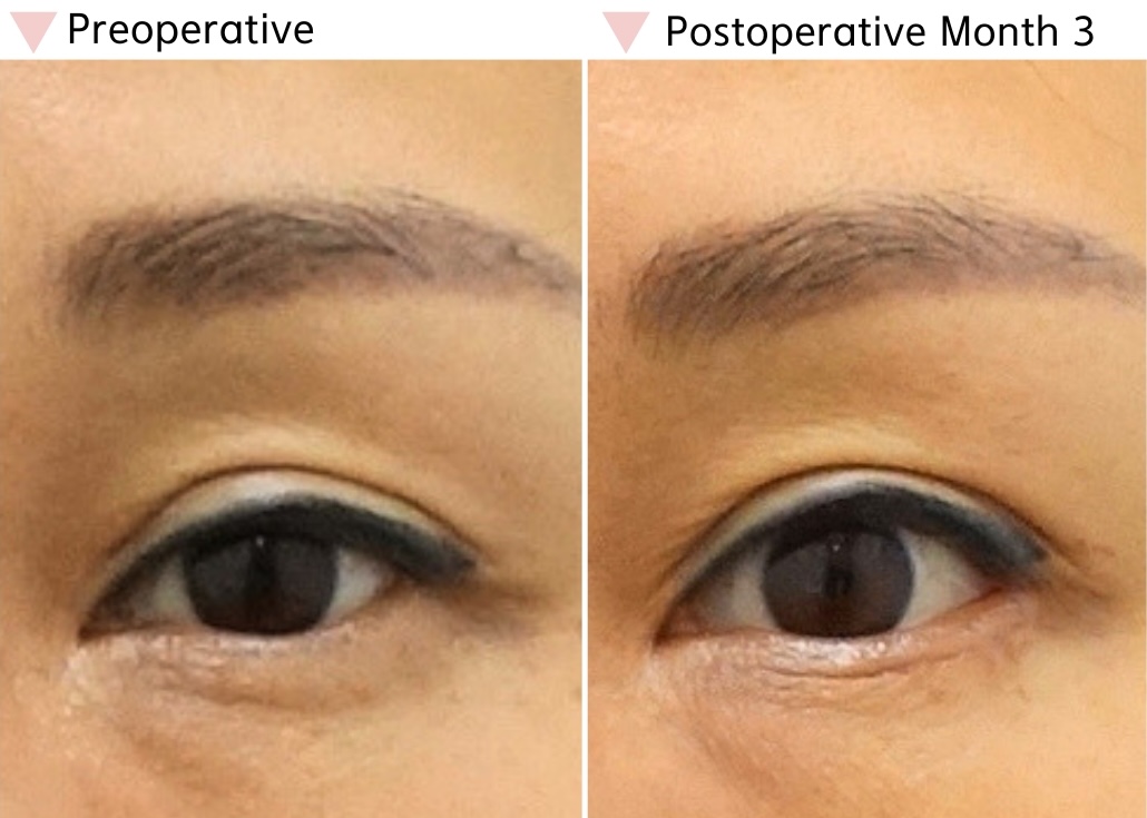 Preoperative and postoperative month 3 comparison showing improved horizontal eye width and more stable eye opening after dual canthoplasty