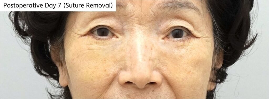 Postoperative day 7 recovery after lower blepharoplasty with fat repositioning in a patient in her 70s